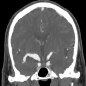 Coronal CTA shows fusiform dilatation  of the right supraclinoid internal carotid artery (ICA). Irregularity from atherosclerotic disease can be seen of the M1 segment of the middle cerebral artery . No significant mural thrombus was noted in this fusiform aneurysm.