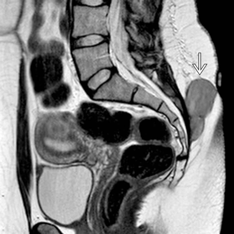 Sagittal T2 MR demonstrates a relatively T2-hypointense mass  in the subcutaneous soft tissues of the posterior pelvic wall in a patient who had felt this mass growing over time.