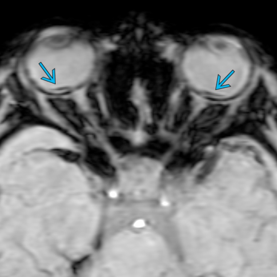 Axial SWI in a 3-month-old with AHT shows thin areas of ↓ signal , consistent with bilateral retinal hemorrhages. MR is insensitive for detection of retinal hemorrhages, but they should be reported when present.