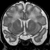 Coronal T2 MR in a newborn with midline skull base clefting reveals 2 pituitary stalks . The normal-sized pituitary stalks project below the optic chiasm toward duplicated pituitary glands.