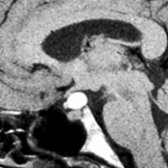 Sagittal T1 MR shows a well-delineated, hyperintense, suprasellar mass that is clearly distinct from the pituitary gland. Rathke cleft cyst was documented at surgery.