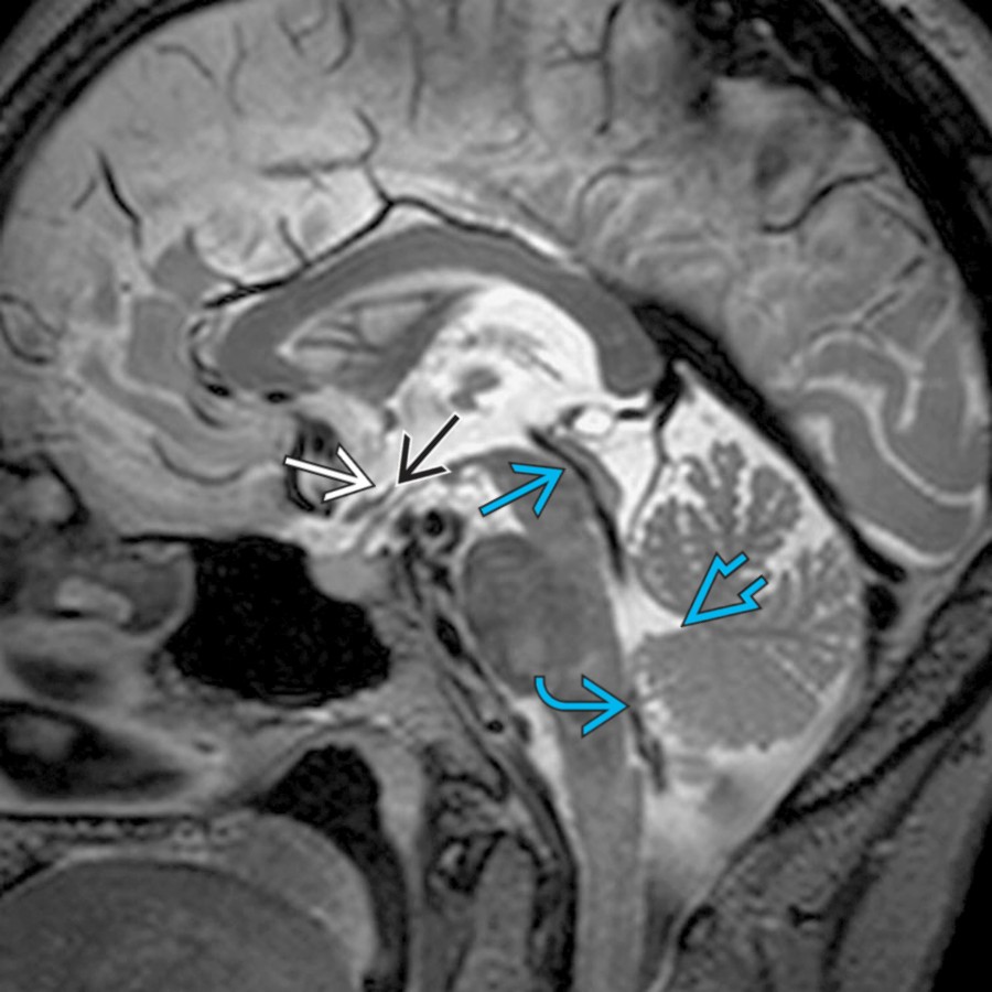 Sagittal T2 SPACE MR shows the normal flow void due to CSF flow at the cerebral aqueduct  and foramen of Magendie . Note the chiasmatic  and infundibular recesses  of the 3rd ventricle and fastigium  of the 4th ventricle.