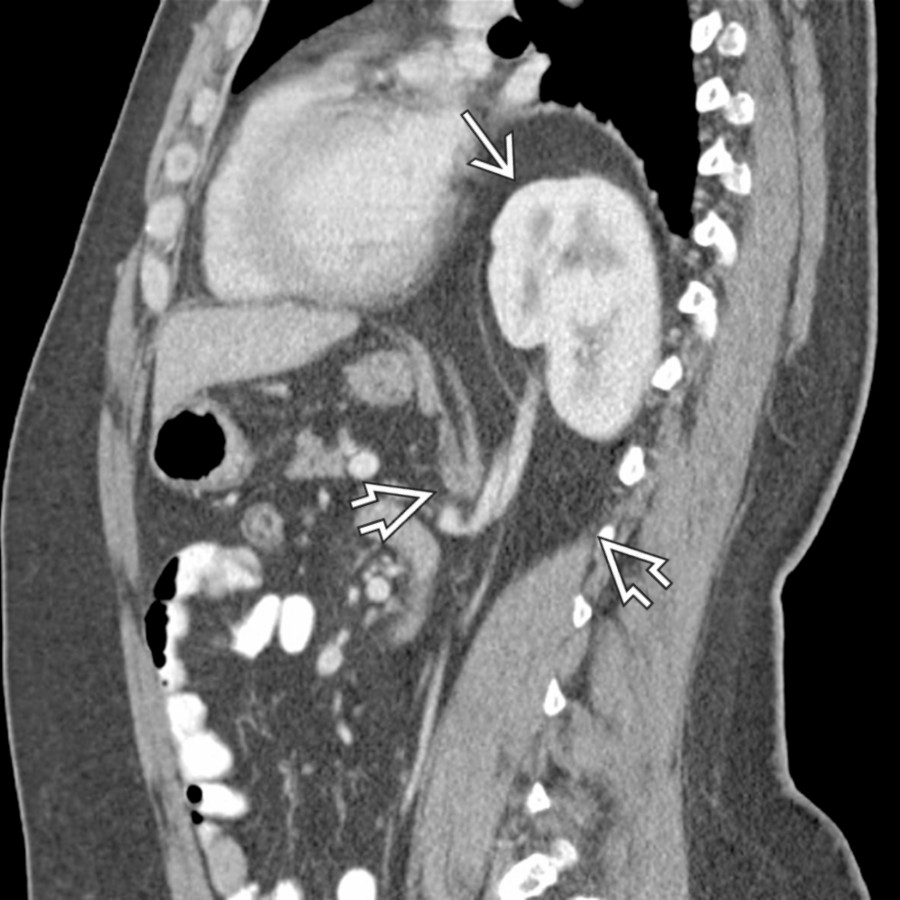 Sagittal CECT shows a large Bochdalek hernia containing bowel and kidney. There is focal interruption of the hemidiaphragm  with herniation of the kidney  into the thorax.
