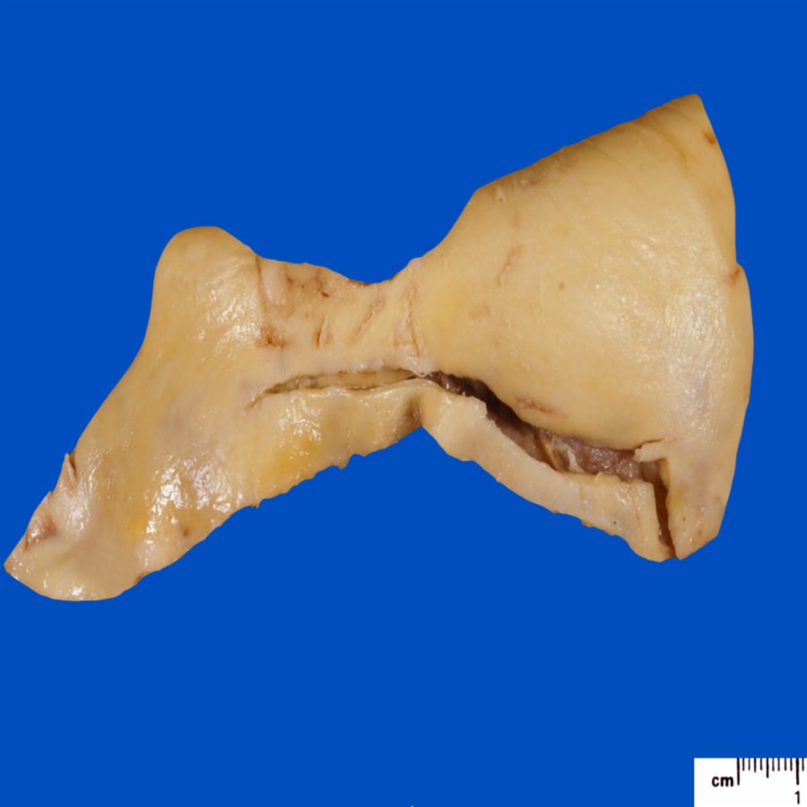 Photograph of the LIT in a resected aortic wall is shown. Note that in vitro, the shape of the tear is mostly linear with a small "L" on the right end. In vivo, in a pressurized aorta, that tear appears stretched open, and exposed underlying adventitial will bulge out (as shown on CT images).