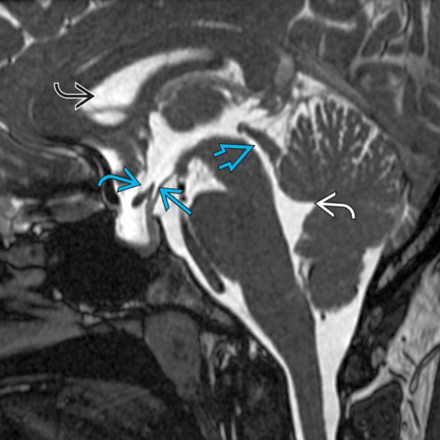 Sagittal FEISTA MR demonstrates the lateral ventricle , chiasmatic  and infundibular  recesses of the 3rd ventricle, the cerebral aqueduct , and the fastigium  of the 4th ventricle. The floor of the 3rd ventricle in formed from front to back by the optic chiasm, hypothalamus, mammillary bodies, and roof of the midbrain tegmentum.