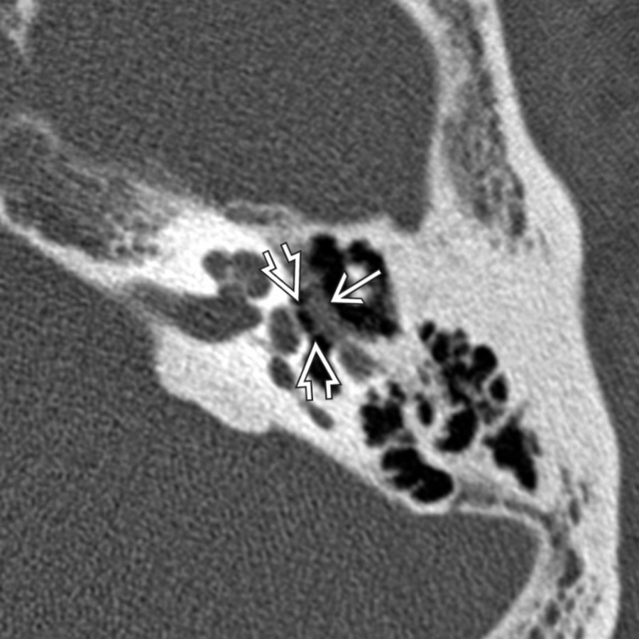 Axial CT in a patient with conductive hearing loss shows the protruding tympanic segment of CNVII  is strung across the middle ear cavity. Notice that CNVII is prominent in size and touches the crura  of the stapes, explaining conductive hearing loss presentation.