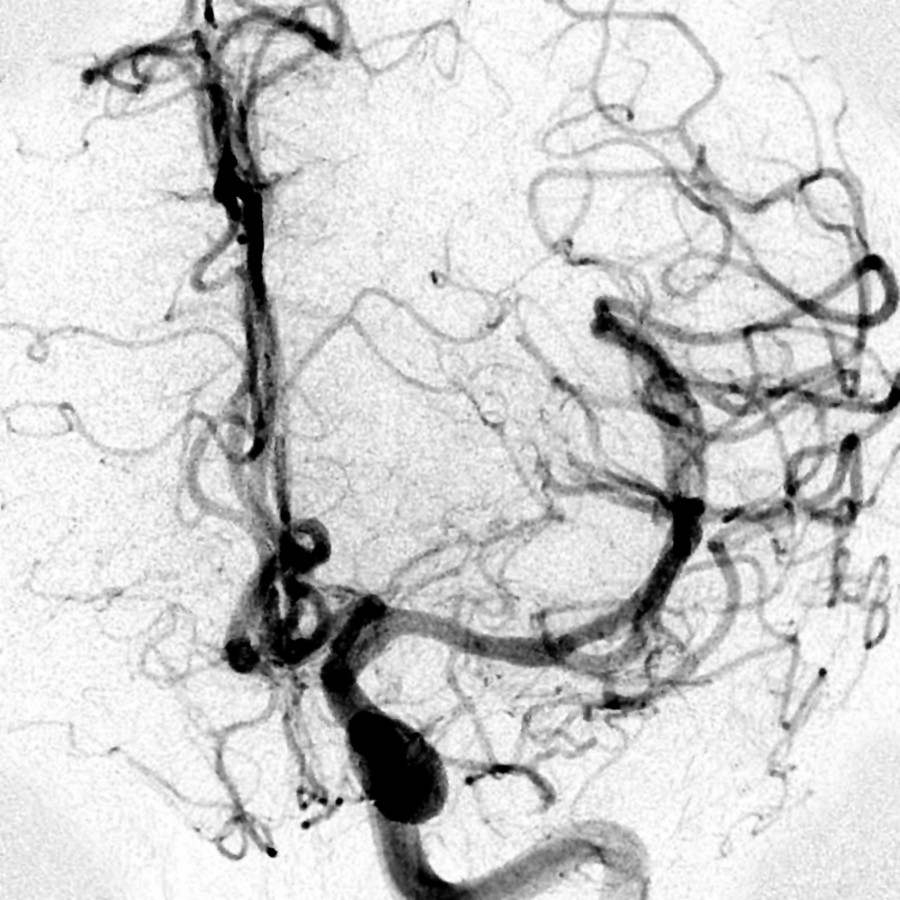 After superselective catheterization of the left MCA and infusion of tissue plasminogen activator for 2 hours, normal circulation was restored, as shown on this AP DSA.