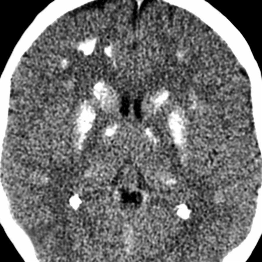 Axial NECT in a patient with with hypothyroidism shows diffuse hyperdense Ca⁺⁺ within the BG, thalami, & subcortical WM. Ca⁺⁺ related to systemic disease is typically symmetric.