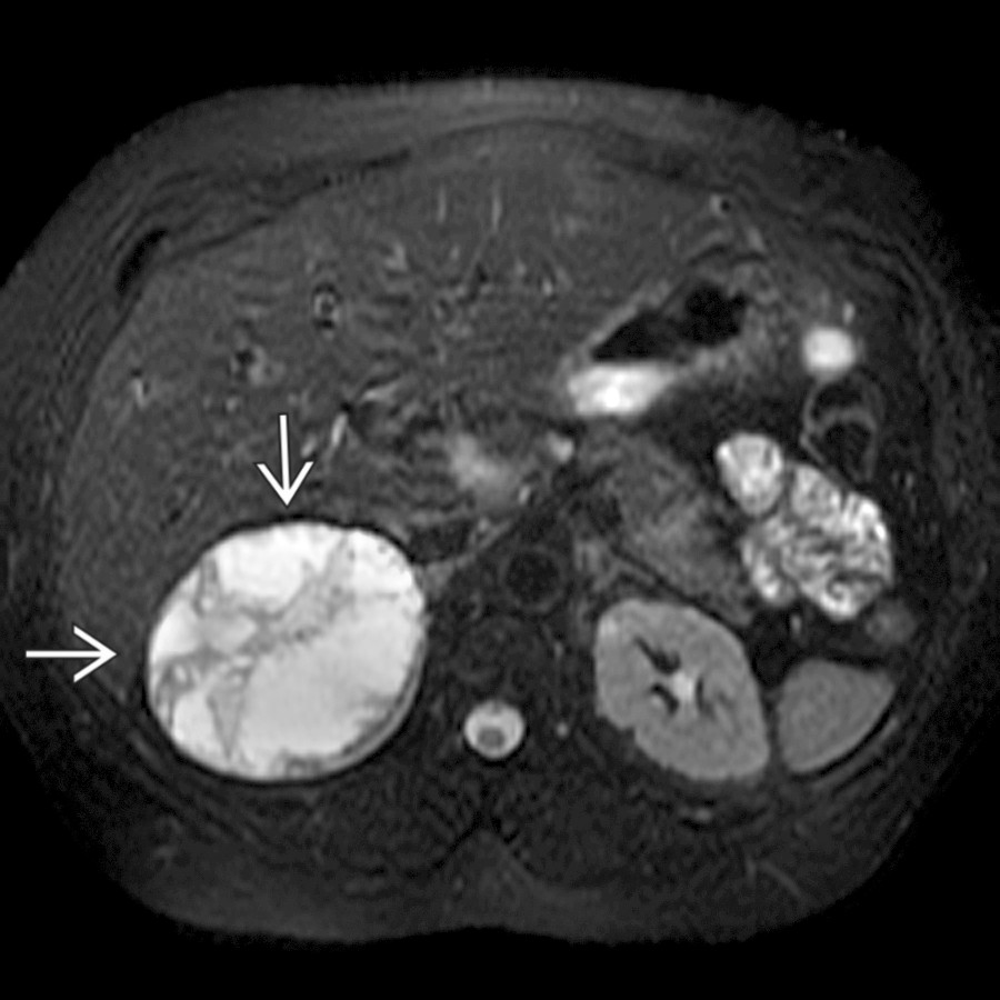 Axial T2 FS MR in a 54-year-old woman with left flank pain shows a 7-cm, complex cystic right adrenal mass with a low-signal hemosiderin ring . A pseudocyst was resected. Signal intensity of pseudocysts varies depending on the age of hemorrhage.