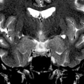 Axial T2WI MR confirms that the mass  is isointense to gray matter.