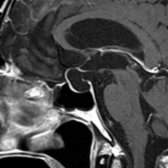 Sagittal T1 C+ MR shows a 71-year-old woman with a sellar and suprasellar arachnoid cyst mimicking an empty sella. Note the normally enhancing pituitary infundibulum  and pituitary tissue  displaced anteriorly by the CSF intensity arachnoid cyst.