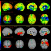 FDG PET raw data & 3D-SSP images of a 59-year-old man with sv-PPA demonstrate decreased metabolic activity in the anterior & medial left temporal lobe  & to a lesser degree in anterior & medial temporal lobe . (Courtesy M. Matesan, MD.)