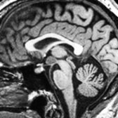 Sagittal T1WI MR in a 36-year-old woman being evaluated for seizures shows a well-delineated mass  that appears to lie within the 3rd ventricle.