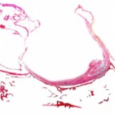 Low-power micropathology shows primary empty sella with downward herniation of CSF-filled subarachnoid space  into the sella. The pituitary gland  is flattened against the sellar floor. (Courtesy W. Kucharczyk, MD.)