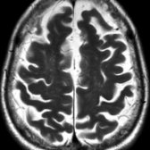 Axial T2WI MR in a patient with cognitive decline, visual hallucination, & parkinsonism shows diffuse cortical atrophy consistent with DLB.