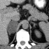 Axial NECT shows a homogeneous, low-density right adrenal adenoma    and a normal left adrenal gland.