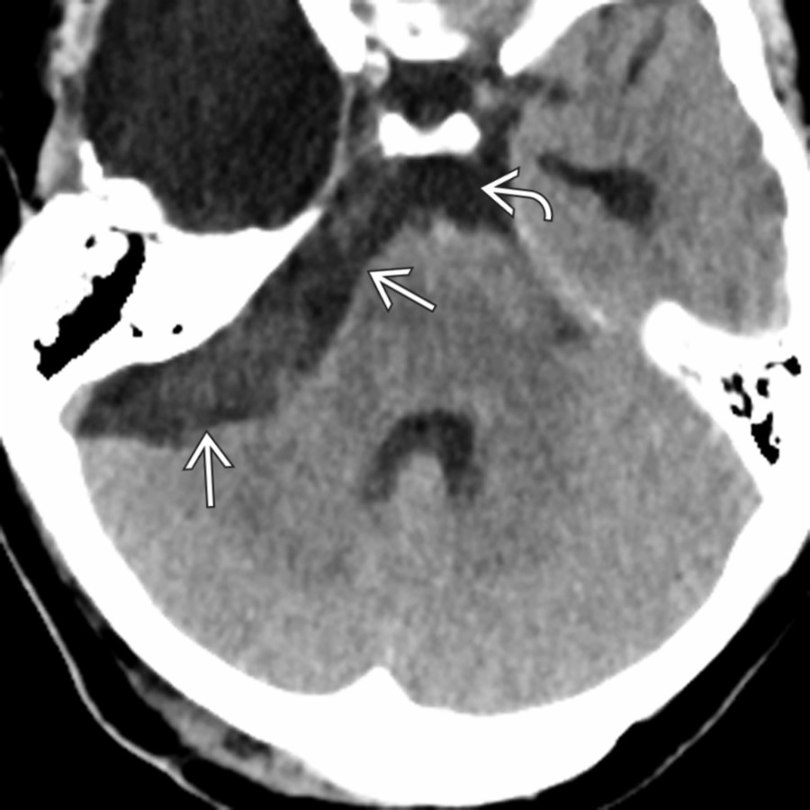 Axial NECT shows a typical epidermoid cyst (EC) in an expanded right CPA cistern. Note that the EC  is slightly more dense than the adjacent CSF  and has a frothy, cauliflower-like surface.