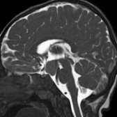 Sagittal FIESTA MR in a 2 year old with seizures and an HH shows the relationship of the hypothalamic mass  with adjacent structures. FIESTA eliminates CSF flow artifact and provides high spatial resolution evaluation of suprasellar lesions with a CSF interface.