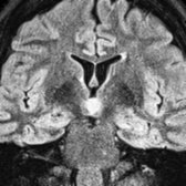 Coronal FLAIR in the same patient shows the lesion  appears slightly hyperintense relative to cortex. The mass did not enhance following contrast administration. This is a classic sessile HH.