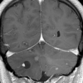 Coronal T1 C+ MR in an adult patient reveals a cystic mass with an intensely enhancing mural nodule  in the posterior fossa. Additional enhancing nodules  are noted in this patient with von Hippel-Lindau.