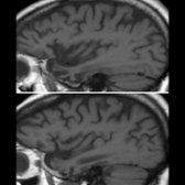 Parasagittal T1WI MR through left (top) & right (bottom) temporal lobes of a 55-year-old man with sv-PPA shows asymmetric temporal lobe atrophy on left    vs. right . Also note relatively preserved frontal lobe  volume.