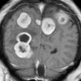 Coronal T1 C+ MR in a patient with primary malignancy demonstrates a cystic and solid, enhancing, nodular mass  with the  surrounding vasogenic edema . Multiple additional lesions  and clinical history can help with diagnosis.
