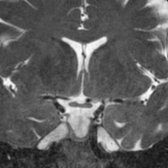 Coronal T2 MR shows primary empty sella seen as incidental finding on screening IAC MR. The sella is filled with CSF and the pituitary gland  is flattened against the sellar floor.