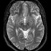 Axial T2 MR in a patient with right mesial temporal sclerosis (not shown) demonstrates ipsilateral volume loss of right mammillary body . The medial limbic (Papez) circuit connects these structures.