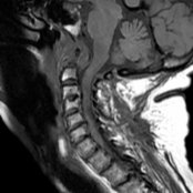 Sagittal T1WI MR shows rheumatoid arthritis (RA) involving C1-C2 articulation with dens erosion and extensive pannus formation . There is mild compression of medulla by the  pannus and obscuration of fat planes.
