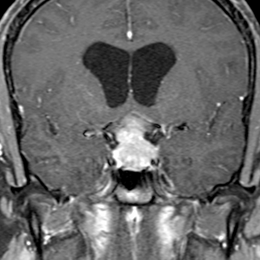 Coronal T1 C+ FS MR in 22-year-old man with diabetes insipidus shows hydrocephalus and an enhancing sellar/suprasellar mass. Germinoma commonly presents with diabetes insipidus. A macroadenoma often has visual defects.