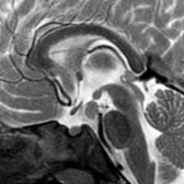 Sagittal T2WI MR in a patient presenting with precocious puberty reveals a pedunculated hypothalamic mass  located between the median eminence and mammillary bodies . The mass is isointense with cortex, typical of a hamartoma.