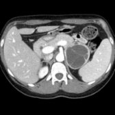 Axial CECT in a hypertensive 36-year-old woman shows a peripherally enhancing, septated, 7-cm left adrenal pheochromocytoma . Enhancing soft tissue should prompt testing for an underlying adrenal neoplasm.