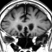 Coronal T1WI MR in the same patient shows focal atrophy of the olfactory gyri . This finding was initially overlooked & the patient was given the imaging diagnosis of Alzheimer disease. Review & subsequent clinical evaluation confirmed FTD.