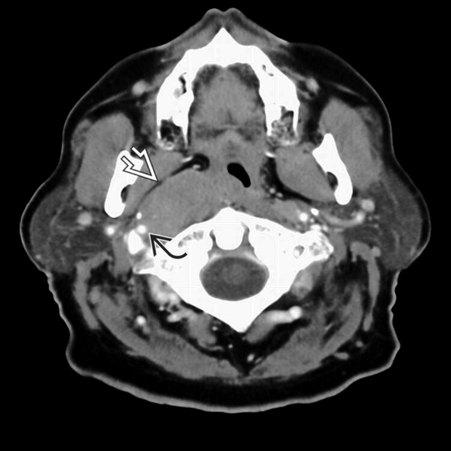 Axial CECT shows a homogeneous mass in the retropharyngeal space, displacing the parapharyngeal fat anterolaterally  and encircling the right internal carotid artery .