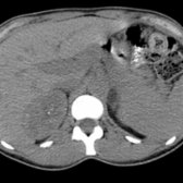 Axial NECT in the same patient shows a 1.5-cm, low-attenuation (5 HU), lipid-rich left adrenal adenoma .