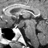 Sagittal T1 C+ MR shows a nonenhancing sessile mass  arising in the hypothalamus and projecting in the posterior suprasellar cistern.
