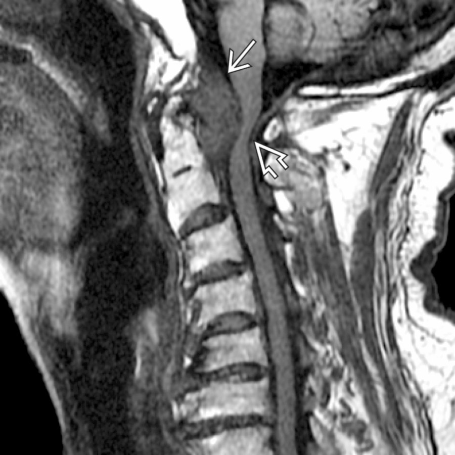 Sagittal T1WI MR shows a large mass with low T2 signal  posterior to the odontoid process with severe cord compression .