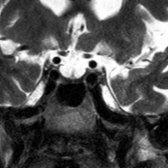 Coronal T2 MR at 3T shows CSF within the sella turcica  surrounding the infundibular stalk . The pituitary gland  is flattened against the sellar floor in this patient with a primary empty sella.