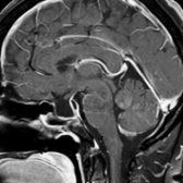 Sagittal T1 C+ FS MR in the same patient shows a thin rim of enhancing pituitary gland   compressed against the expanded sellar floor. The infundibulum is kinked over the dorsum sellae  .