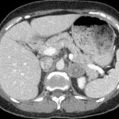 Axial CECT in a 68-year-old woman with colon cancer shows an indeterminate-signal, heterogeneous left adrenal mass  (HU 65) with relatively low central attenuation.