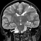 Coronal STIR MR shows a small, open-lipped left hemisphere cleft lined by GM with thickened gyri of pachygyria  & outpouching of ventricular margin , pointing to schizencephaly. Contralateral forme fruste schizencephaly does not reach ventricular margin .