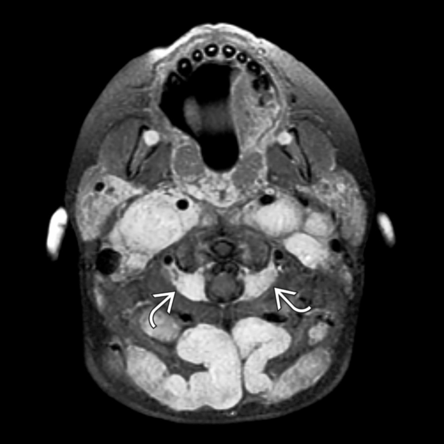 Axial T1 C+ FS MR shows the appearance of multiple neurofibromas in a child with neurofibromatosis type 1 with bilateral, symmetric masses involving neural foramen  in the carotid sheath and posterior cervical space, consistent with neurofibromas.