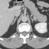 Both limbs of the right adrenal are seen on this section.
