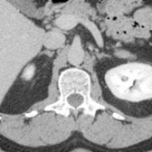 The lowest portions of the adrenals are seen on this section.