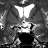 Coronal T2 MR in the same patient shows a thin, nearly inapparent pituitary gland remnant along the sellar floor . The history distinguishes Sheehan syndrome from an incidental finding of partial empty sella.