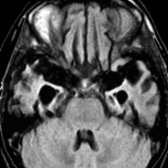 Axial FLAIR MR shows atrophy of both the frontal & temporal lobes. Note compensatory enlargement of the temporal horns    due to temporal lobe volume loss.