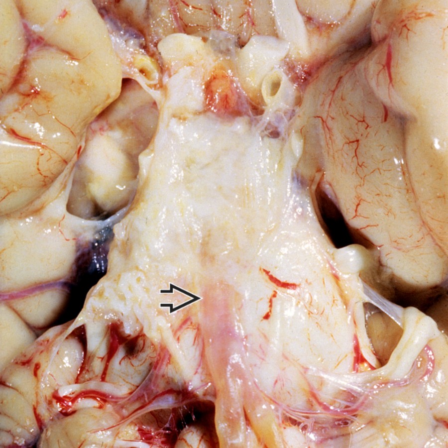 Gross pathology shows an epidermoid cyst extending anterosuperiorly from the cerebellopontine angle (CPA) cistern, insinuating within the prepontine cistern and encasing the basilar artery . Note its typical pearly appearance. (Courtesy E. Hedley-Whyte, MD.)