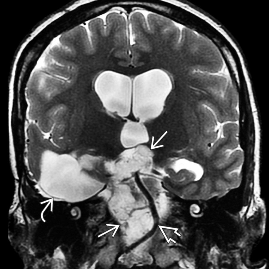 Coronal T2 MR shows the lobulated, hyperintense mass  encases and displaces the basilar artery . CSF in the right middle fossa  is a cavity from prior attempted resection.