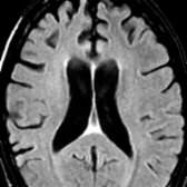 Axial FLAIR MR in a patient with early findings of FTD shows relatively mild frontal lobe volume loss     compared to the normal appearance of the parietal lobes.