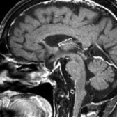 Sagittal T1 C+ FS MR shows an ES secondary to surgery for pituitary macroadenoma. There is little pituitary tissue apparent along the enlarged sellar floor .